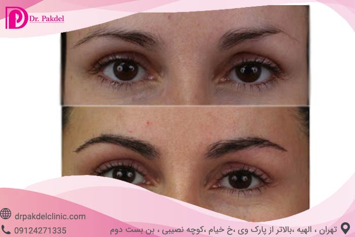 [تصویر:  Eyebrow-transplantation-6.jpg]