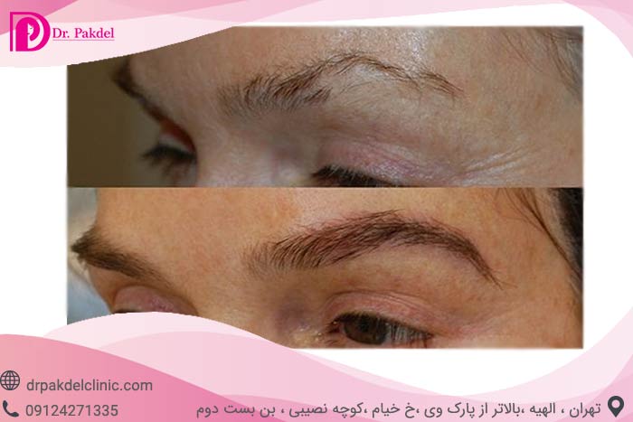 Eyebrow-transplantation-7