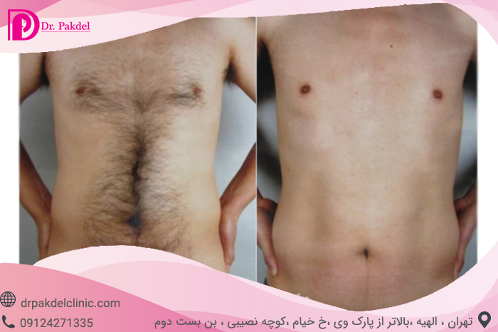 Laser-hair-removal-2