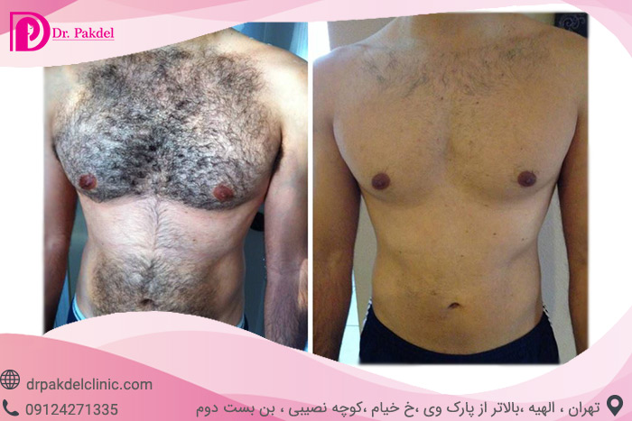 Laser-hair-removal-3