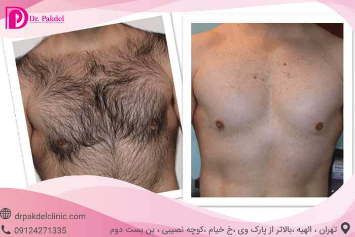 Laser-hair-removal-4