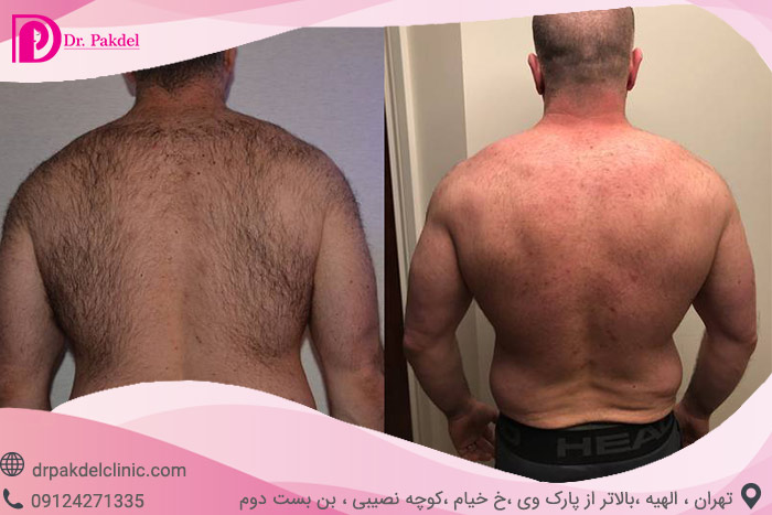 Laser-hair-removal-5