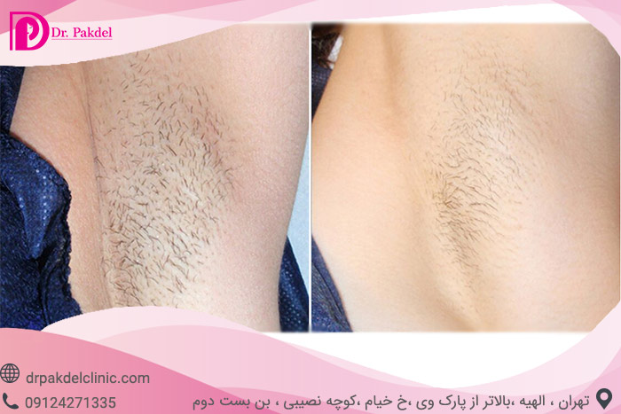 Laser-hair-removal-6