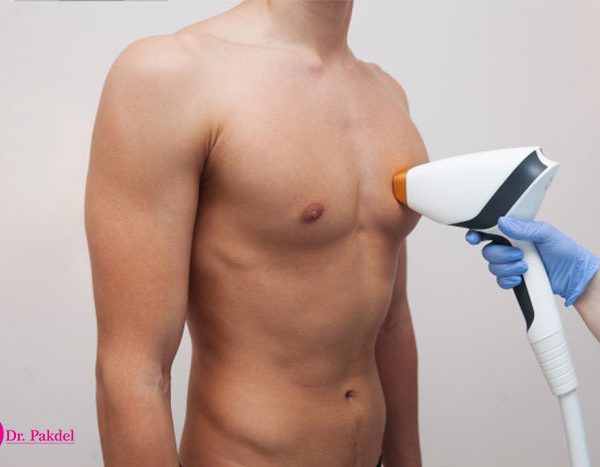 Laser-hair removal