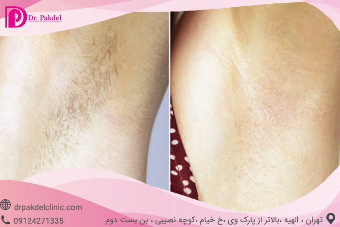 Laser-hair-removal-7