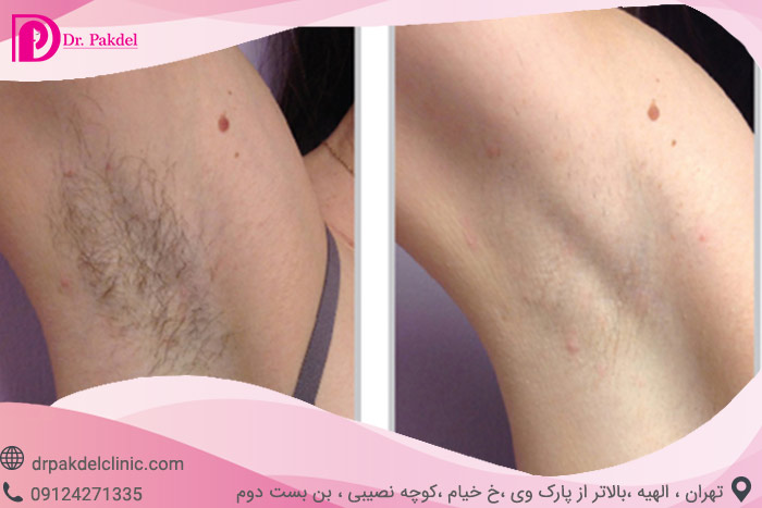 Laser-hair-removal-8