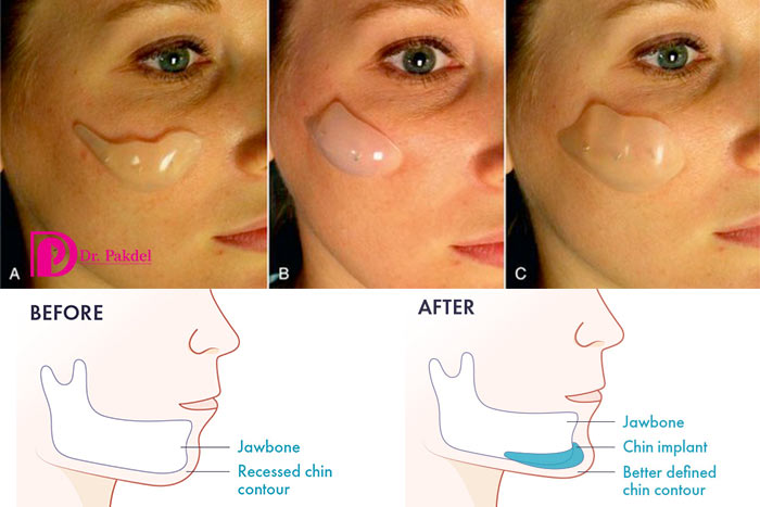 Cheek and chin prosthesis