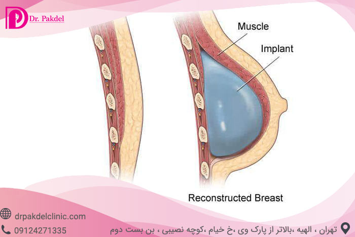 Breast-prosthesis-11