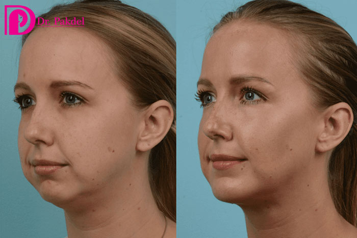 Removing-facial-fat-1