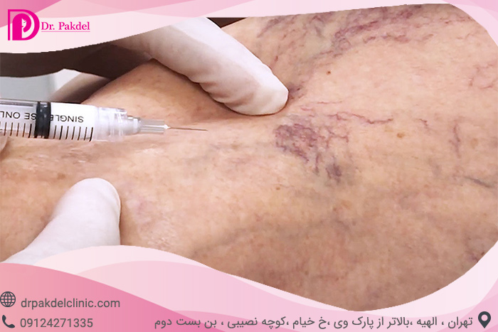 Sclerotherapy-2