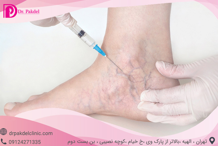 Sclerotherapy-4