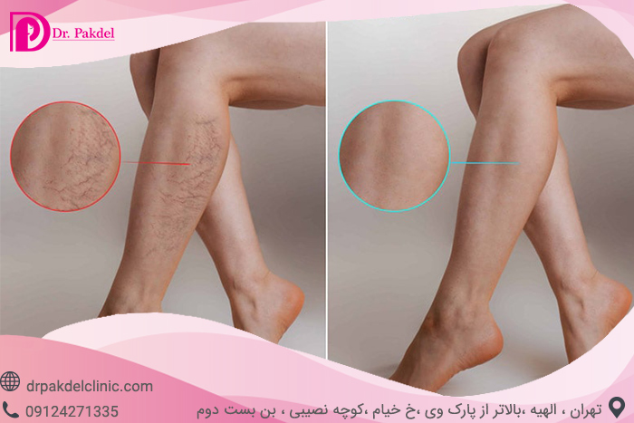 Sclerotherapy-6
