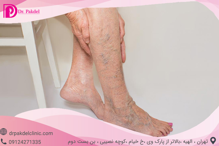 Sclerotherapy-7