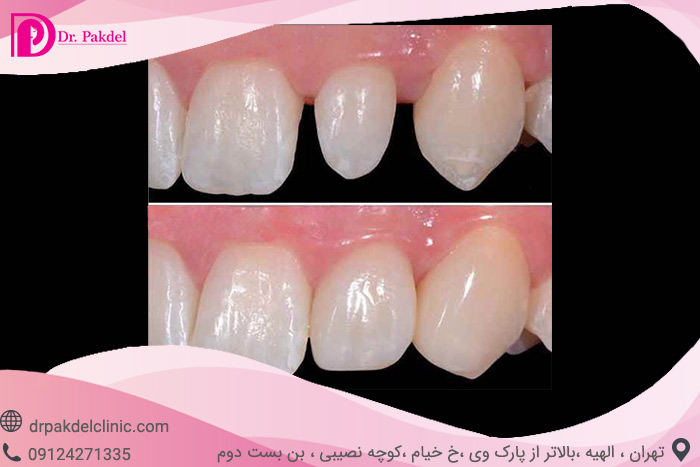 Dental composite-7