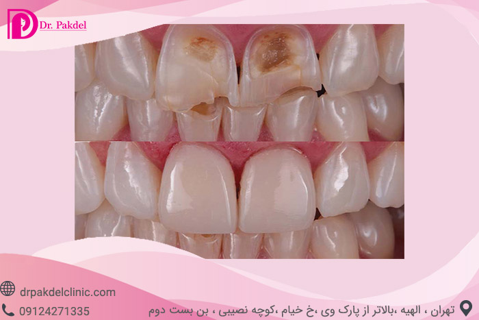 Dental composite-8