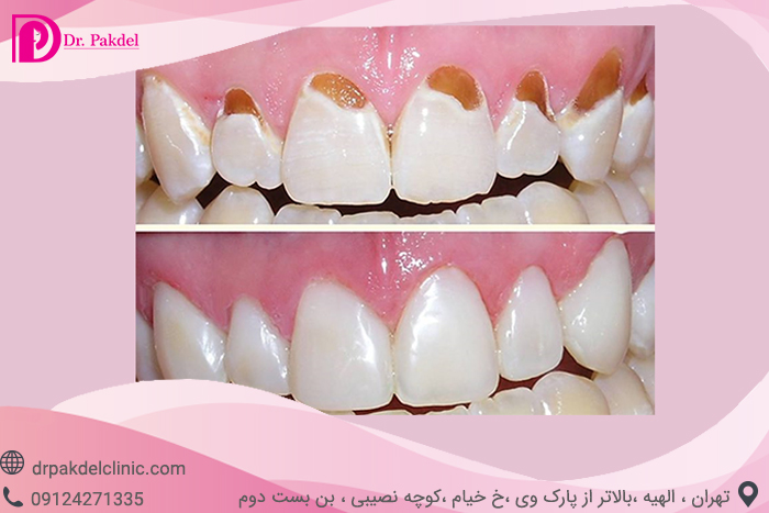 dental-laminate-13