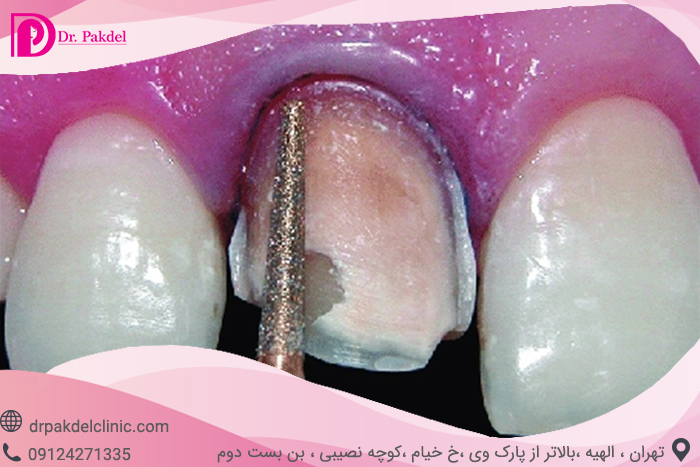 dental-laminate-15