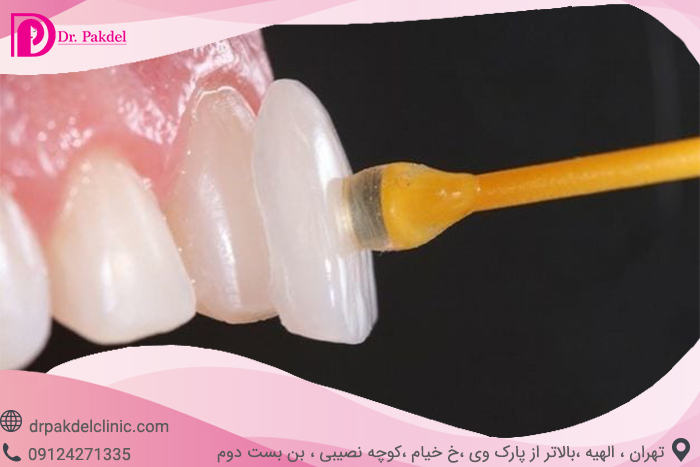 dental-laminate-3