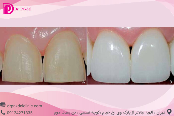 dental-laminate-8