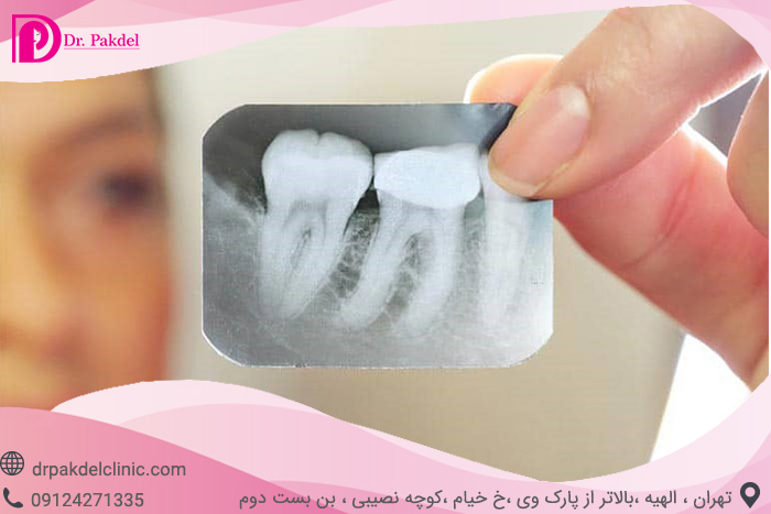 Tooth root canal-14