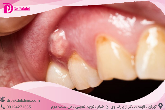Tooth root canal-16