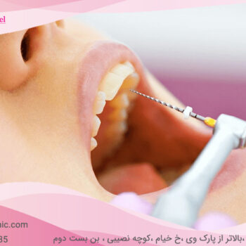 Tooth root canal-18