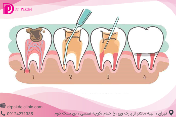 Tooth root canal-2