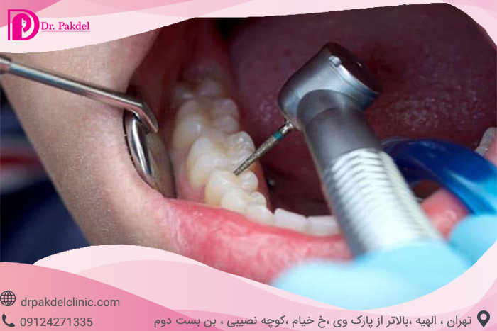 Tooth root canal-4