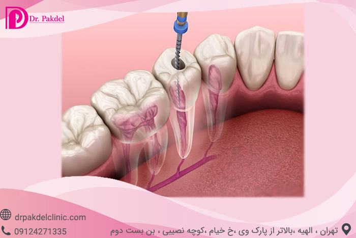 Tooth root canal-5
