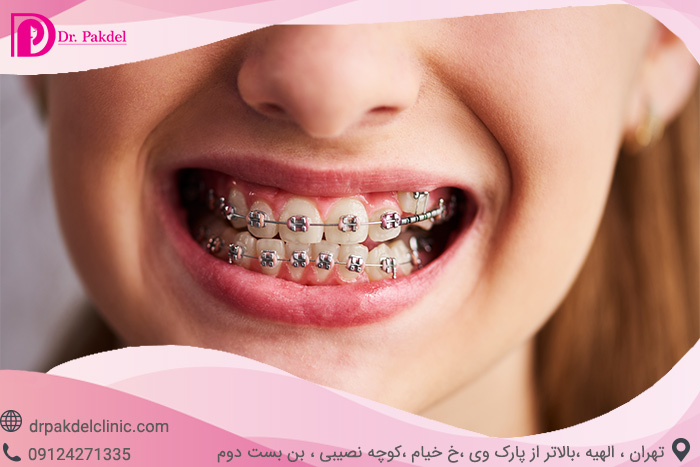 Dental orthodontics-13