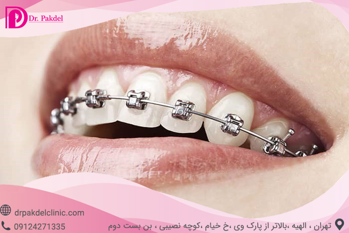Dental orthodontics-14