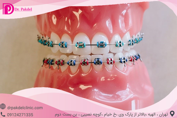 Dental orthodontics-20