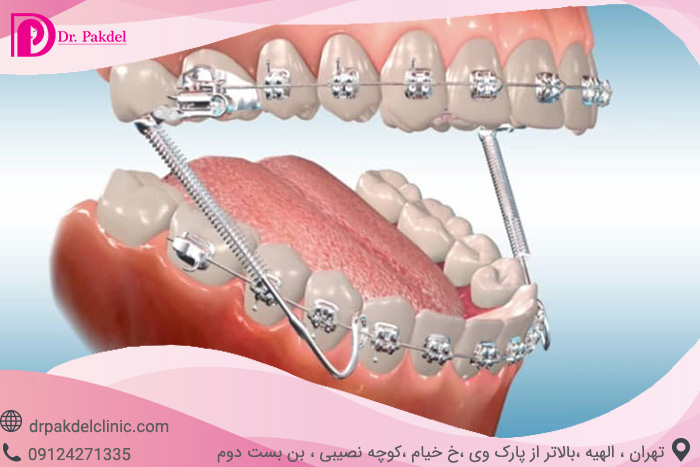 Dental orthodontics-3