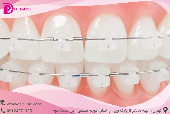 Dental orthodontics-4