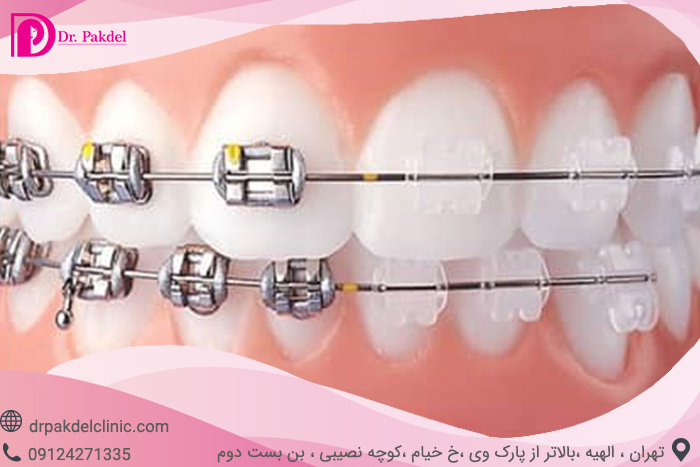 Dental orthodontics-6