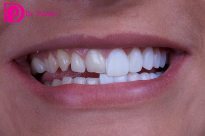 Dental-laminate-drpakdelclinic-1