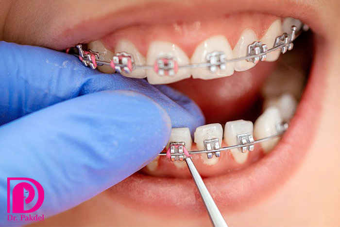 Dental orthodontics-25