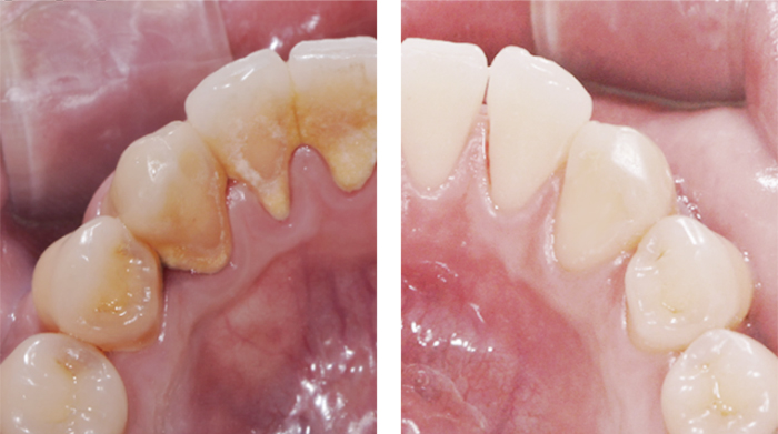 Teeth scaling drpakdel