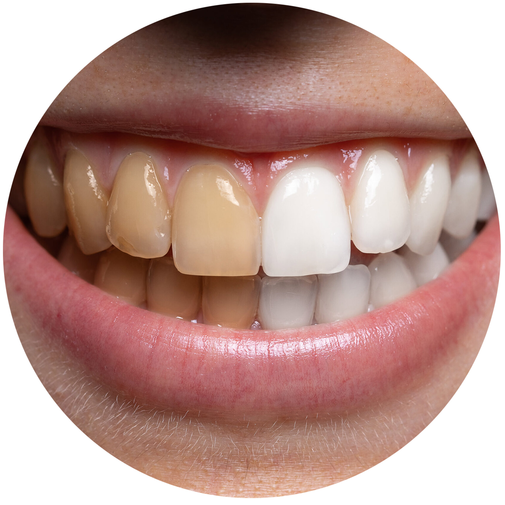 Tooth-bleaching-drpakdel