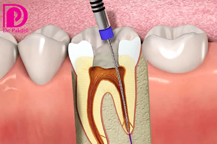 root-canal-21